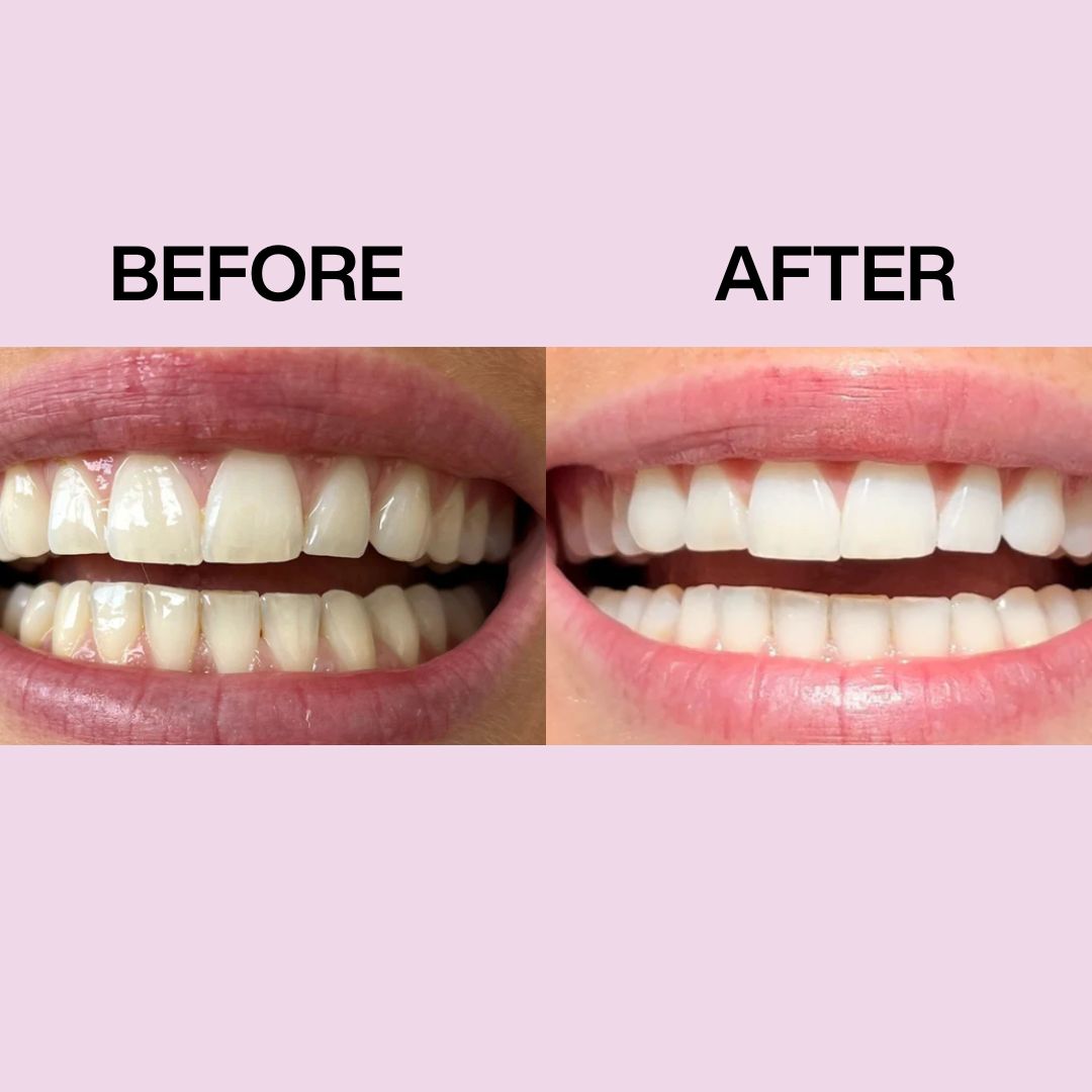 Gem Whitening Strips - 28 satchets
